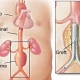 Abdominal Aort Anevrizmaları