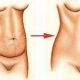 Abdominoplasti Karın Germe Ameliyatı