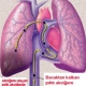 Akciğer Embolisi Nedir?
