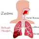 Akciğer Lobu Zatürreesi Nedir?