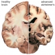 Alzheimer Nedir?