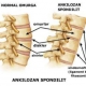 Ankilozan Spondilit
