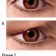 Blepharoplasty