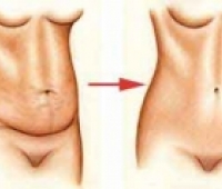 Abdominoplasti Karın Germe Ameliyatı