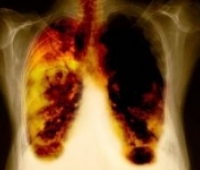 Akciğer Kanseri