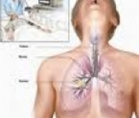 Akciğer Kistleri Nasıl Tedavi Edilir?