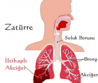 Akciğer Lobu Zatürreesi Nedir?