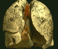 Akciğer Tümörleri