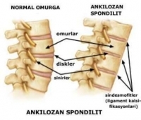 Ankilozan Spondilit