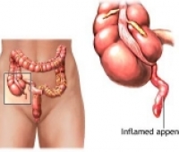 Apandisit Hastalığı Nedir?