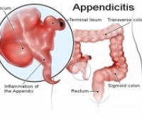 Apandisit Nedir?