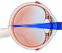 Astigmat Nedir?