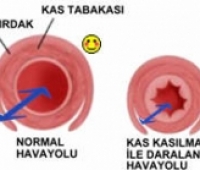 Astım Bronşit