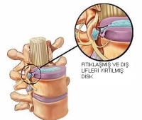 Bel Fıtığı