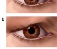 Blepharoplasty