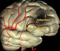 Braın Infarctıon