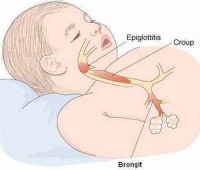 Bronşit
