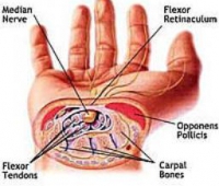Carpal Tünel Sendromu