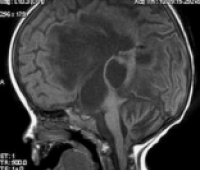 Chiari Malformasyonu