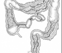 Crohn Hastalığı Regional Enterit