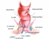 Crohn Hastalığı