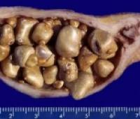 Safra Taşı Tedavisi